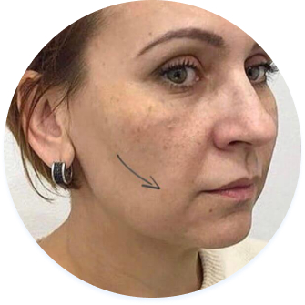 обличчя до процедури