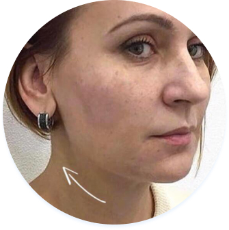 обличчя після процедури